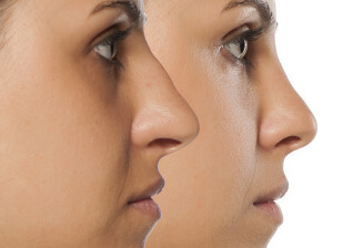 rinoplastia medellin